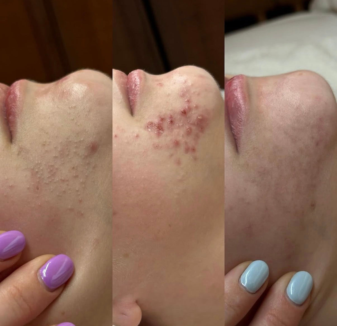 Why Your Skin Purges Before It Clears: What to Expect With New Treatments and Products